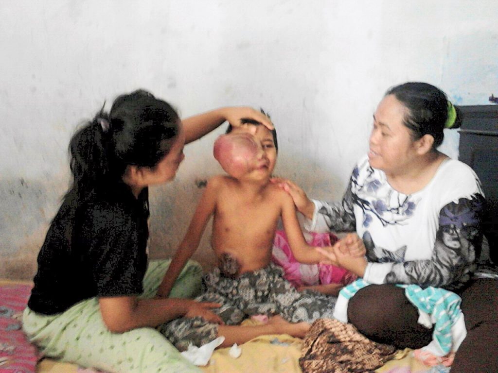 Inilah Andini gadis kecil warga Bedahan, Sawangan, Depok yang terserang tumor ganas.